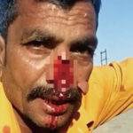 バイク事故により鼻の大半が抉れてた男性（インド）