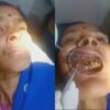 歯茎からたくさんのウジ虫を除去する映像（インド）